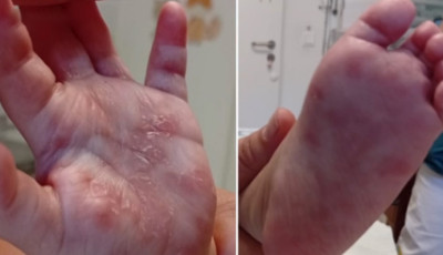 Kiskor&uacute; &eacute;s drogos anyuk&aacute;k: B&aacute;cs-Kiskunban n&eacute;gy csecsemő halt meg id&eacute;n velesz&uuml;letett szifiliszben