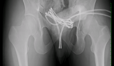 Fel akarta mag&aacute;t izgatni a sr&aacute;c, beszorult a h&uacute;gycs&ouml;v&eacute;be az USB k&aacute;bel